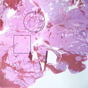 At low power, the majority of the specimen consists of decidua (square) and gestational-type endometrium (circle).