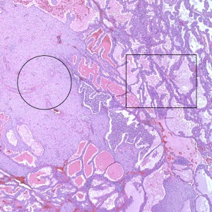 At medium power, we also see decidua (circle) and gestational endometrium (rectangle)