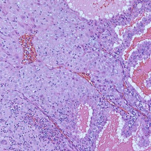 Higher power of unremarkable decidua with gestational-type endometrium