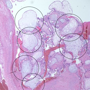 At low power we see throughout the specimen that numerous enlarged hydropic chorionic villi are present (circles).