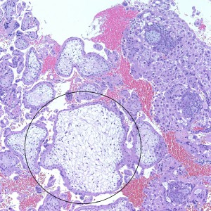 As we can see, enlarged and hydropic chorionic villi are not especially difficult to find (circle). None of these villi however demonstrate trophoblastic inclusions. There are rare interspersed small chorionic villi (top left) however they are generally rare. 