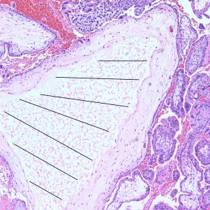 Some villi are so large and hydropic that a few have actually developed central cisterns, spaces within the center of the villi (space highlighted by horizontal lines).