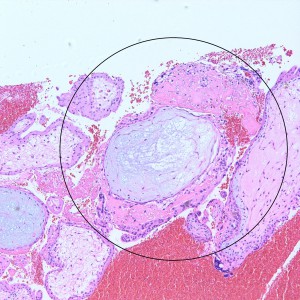 Hydropic villi with some circumferential trophoblastic proliferation.