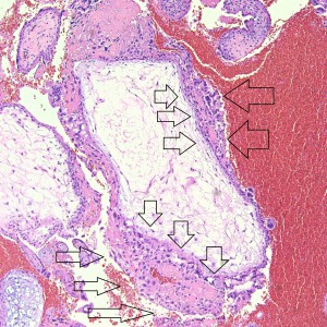 This large hydropic villus with central cistern also demonstrates an important finding: the loss of polarity of the surrounding trophoblasts with circumferential proliferation of variably atypical trophoblastic cells (arrows).