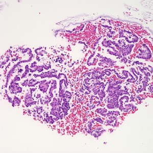 The biopsy contains rare areas like this with scan strips of surface tubal and lower uterine segment epithelium, but without any real appreciable glandular tissue.