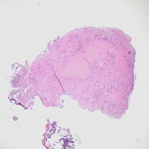 However, in one field we see a well-circumscribed nodule that, on low power, is very pink and glassy appearing, with large cells admixed.