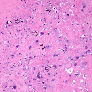 On higher power, we can see that this nodule is mostly composed of this pink amorphous material with interspersed large, round cells with abundant eosinophilic and sometimes clear cytoplasm (arrows). There are essentially no mitoses and atypia is not very prominent.