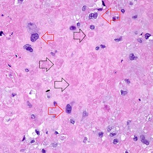 On higher power of the acellular areas we can see vague outlines of the cells that may have been there and have now degenerated into this hyalinized stroma (black arrows). The cells that remain are large, round to oval, with dense eosinophilic to clear cytoplasm (red arrows).